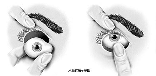 真假難辨，義眼移植術(shù)帶你重拾自信
