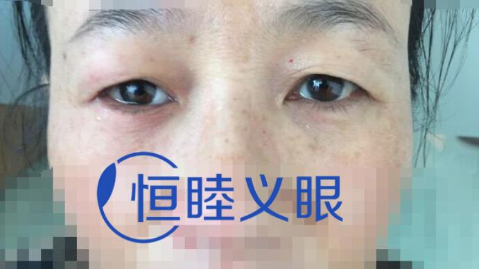 周阿姨手術(shù)后來(lái)我中心定制義眼片