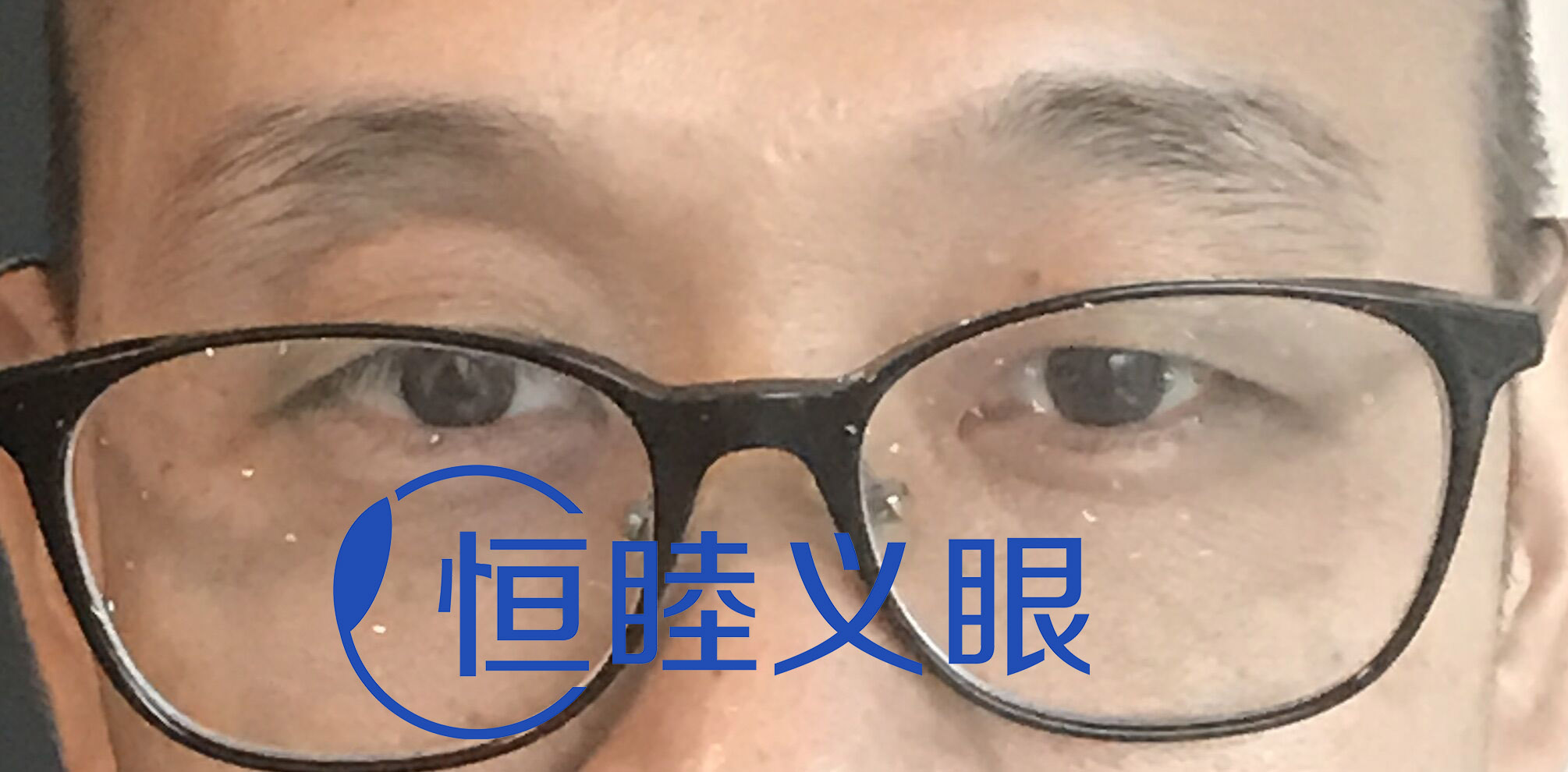 深圳龍華計(jì)先生佩戴前后對(duì)比