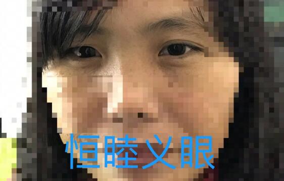 深圳龍崗賴小姐義眼佩戴前后對(duì)比