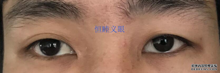林先生佩戴更換義眼片，保留眼球，眼球萎縮