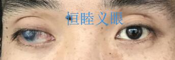 廢用性斜視，眼球突出通過(guò)義眼片改善吳先生外