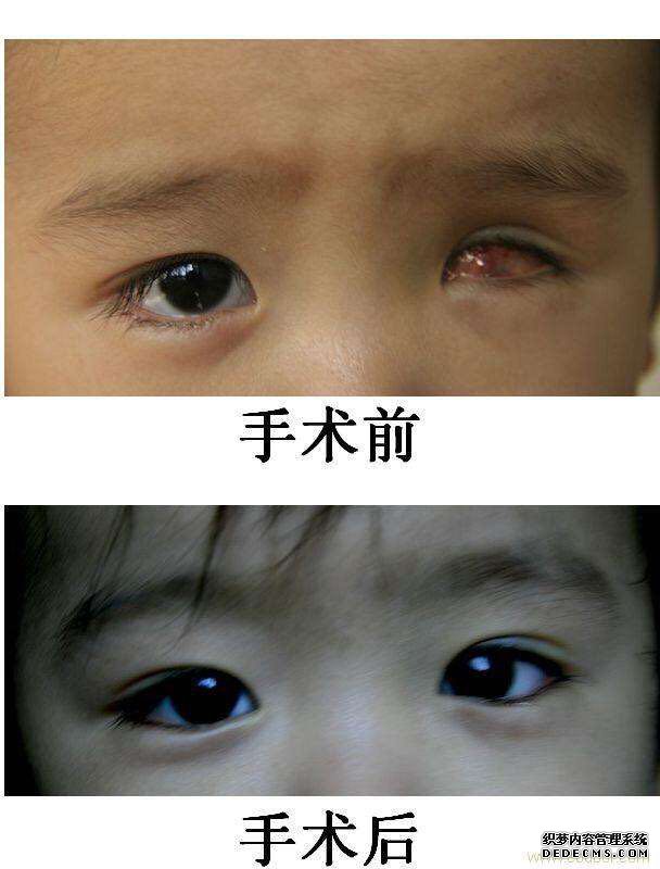 兒童佩戴義眼效果圖