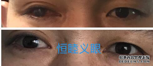 佩戴義眼的客戶