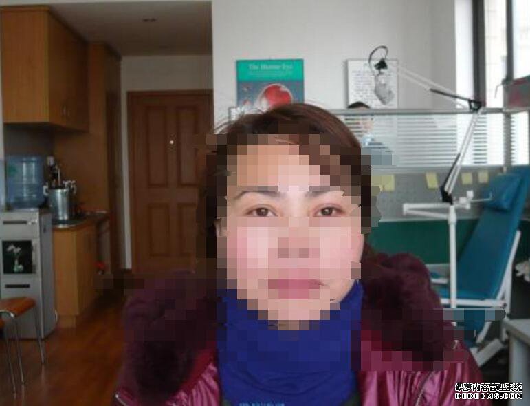 隱形義眼改善外觀