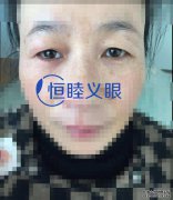 <b>義眼的作用究竟有哪些？下面為大家分析幾點(diǎn)。</b>